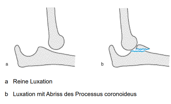 <p>a) Reine Luxation</p><p>b) Luxation mit Abriss des Processus coronoideus</p>