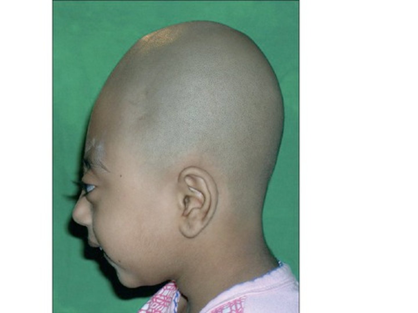 <p>Premature fusion of all cranial sutures resulting in a cone shaped skull. Is the most severe form of craniosynostosis.</p>