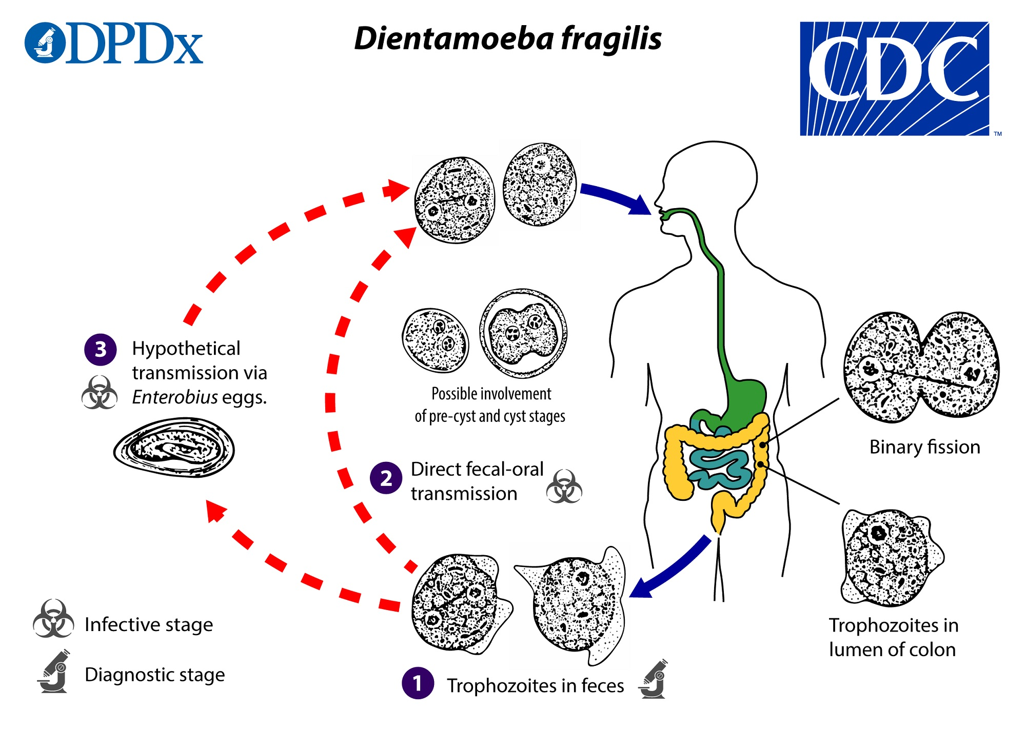 <p><strong>occasionally pathogenic</strong> </p><ul><li><p><strong>Type</strong>: Flagellate (but <strong>no external flagella</strong>); worldwide.</p></li><li><p><strong>ID</strong>: <strong>4–12(15) μm</strong> trophs; <strong>1–2 nuclei</strong> (20–40 percent are uninucleate); <strong>fragmented karyosome (3–5 granules)</strong>; <strong>no peripheral chromatin</strong>; “dirty” cytoplasm. <strong>Not seen on wet preps or in concentrates</strong>; cyst stage recently described.</p></li><li><p><strong>Symptoms</strong>: Colicky pain, fatigue, weight loss (variable).</p></li><li><p><strong>Bloody stool?</strong> No.</p></li><li><p><strong>Testing</strong>: Permanent stained smears; molecular if available.</p></li></ul><p></p>