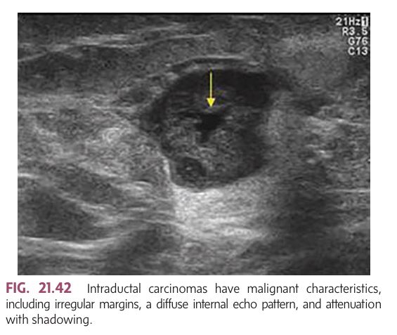 <p></p><p class=""><strong>Description:</strong><br>A type of <strong>intraductal carcinoma</strong> filled with <strong>yellow, paste-like necrotic material</strong> (comedones).</p><p class=""><strong>Forms:</strong></p><ul><li><p class=""><strong>Invasive and noninvasive</strong> types exist</p></li></ul><p class=""><strong>Signs &amp; Symptoms:</strong></p><ul><li><p class="">May have <strong>no clinical findings</strong></p></li><li><p class=""><strong>Clear nipple discharge</strong> more common than bloody</p></li><li><p class="">May cause <strong>pain</strong> or a <strong>crawling sensation</strong></p></li><li><p class="">With early invasion: <strong>minimal thickening</strong> may be felt</p></li><li><p class="">With progression: <strong>nipple retraction</strong>, <strong>dominant mass</strong>, <strong>fixation</strong></p></li></ul><p class=""><strong>Mammographic/Sonographic Findings:</strong></p><ul><li><p class=""><strong>Microcalcifications</strong> commonly seen</p></li><li><p class="">Malignant features:</p><ul><li><p class=""><strong>Irregular margins</strong></p></li><li><p class=""><strong>Diffuse internal echoes</strong></p></li><li><p class=""><strong>Shadowing/attenuation</strong></p></li></ul></li></ul><p class=""><strong>Other Notes:</strong></p><ul><li><p class="">Other DCIS types include <strong>intracystic papillary carcinoma</strong> and <strong>Paget disease</strong></p></li></ul><p></p>