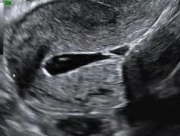 <p> <strong><em>Intrauterine synechiae </em></strong>(<em>endometrial adhesions, Asherman syndrome</em>) are found in <strong><em>women with</em></strong></p><p class="p1"><strong><em>posttraumatic or postsurgical histories, including uterine curettage</em></strong>. Synechiae can <strong><em>cause infertility</em></strong></p><p class="p1"><strong><em>or recurrent pregnancy loss.</em></strong></p><p class="p1"> Sonographic Findings: Ultrasonography may demonstrate <strong><em>bright echoes within the endometrial cavity</em></strong></p><p class="p1">in this condition.</p><p class="p1"> The diagnosis is difficult unless fluid is distending the endometrial cavity. <strong><em>This is best identified</em></strong></p><p class="p1"><strong><em>during the secretory phase when the endometrium is more hyperechoic.</em></strong></p><p class="p1"> Synechiae are more easily <strong>observed in the gravid uterus</strong>, where they appear as a hyperechoic band</p><p class="p1">traversing the uterus from anterior to posterior.</p><p class="p1"> Sonohysterography is an excellent technique for demonstrating adhesions and should be performed in</p><p class="p1">cases of suspected adhesions. Adhesions appear as bridging bands of tissue that distort the cavity or as</p><p class="p1">thin, undulating membranes that connect from one side of the uterus to the other. Thick, broad-based</p><p class="p1">adhesions may prevent distention of the uterine cavity. Adhesions can be divided under hysteroscopy.</p>