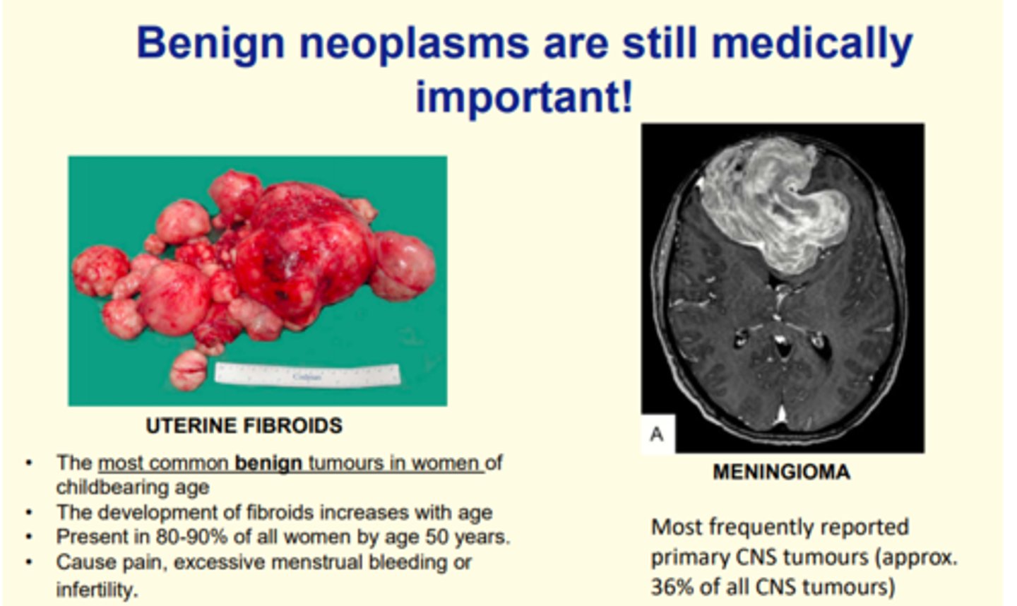 <p>1) UTERINE FIBROIDS</p><p>The development of fibroids increases with age and causes pain, excess menstrual bleeding or infertility</p><p>2) MENINGIOMA</p><p>Most frequently reported primary CNS tumour. </p>