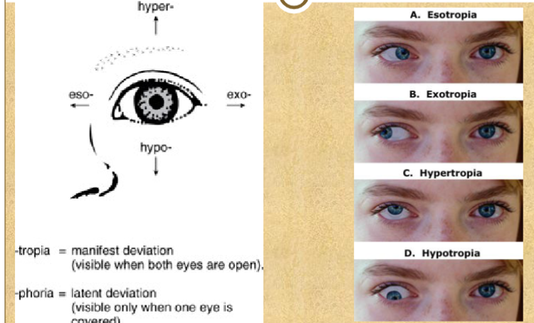 <p>Tropia - visible when both eyes are open</p><p>Phoria- visible when one eye is covered</p>