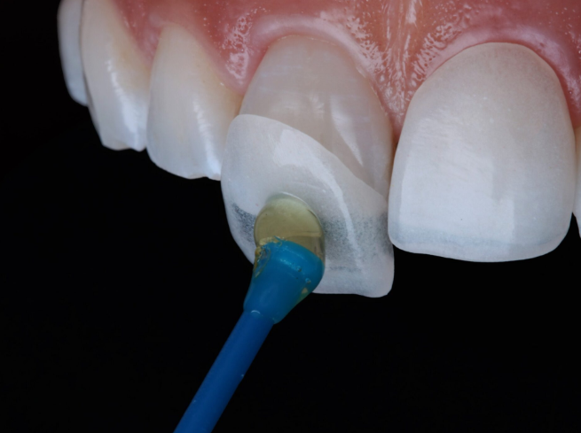 <ul><li><p>minimal invasive </p></li><li><p>allows certain corrections of the size and the colour of teeth </p></li><li><p>can be considered as an alternative to orthodontic treatment </p></li><li><p>highly esthetic material </p></li></ul><p></p>