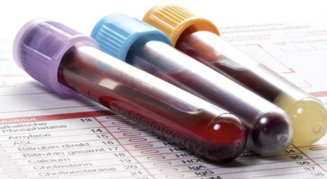 <p>hemophagocytic syndrome:</p><p>-anemia (regenerative)</p><p>-thrombocytopenia</p><p>-hypoalbuminemia</p><p>-hypocholesterolemia</p>