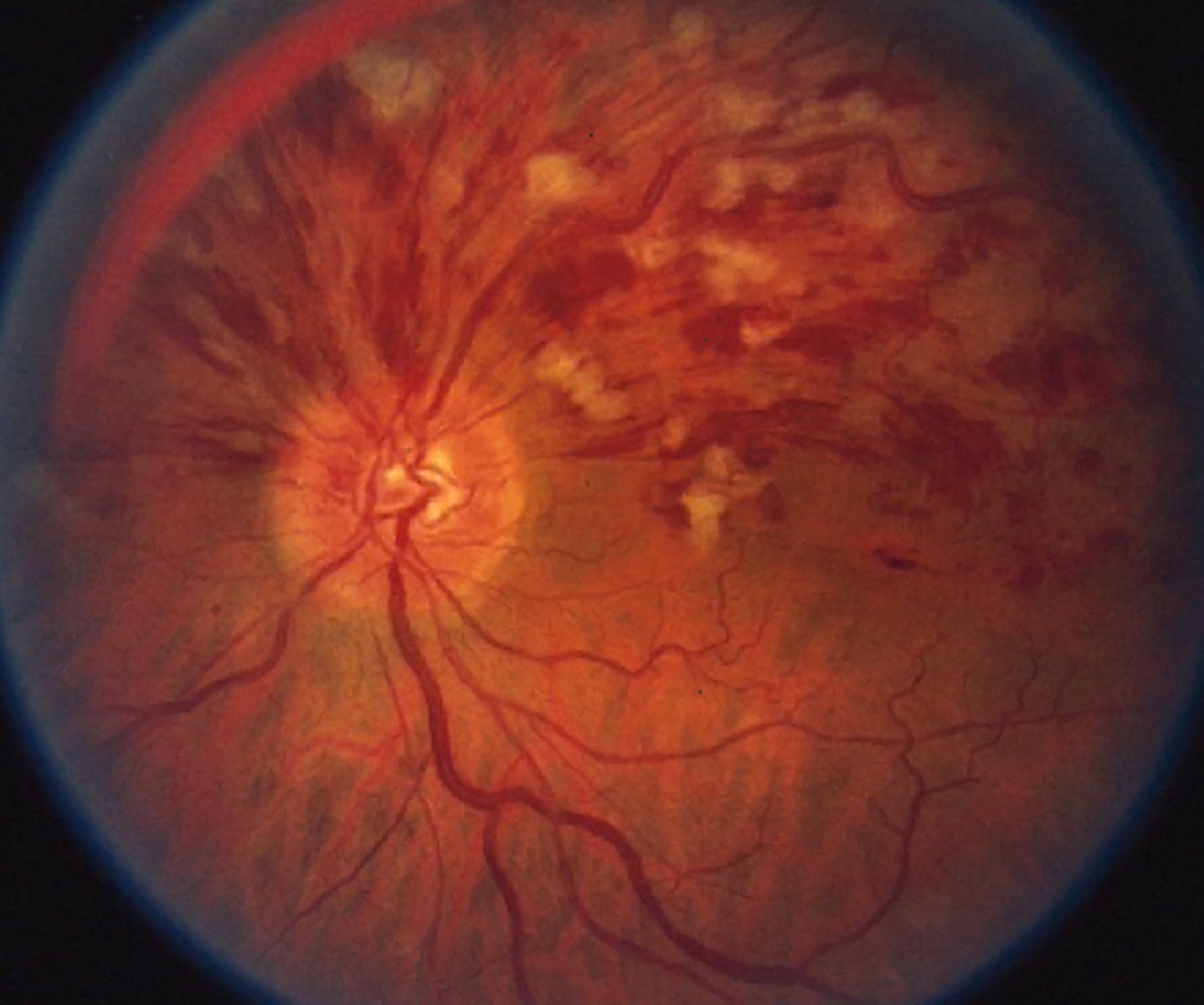 <p>BRVO = venous stasis retinopathy with edema, hemes</p>