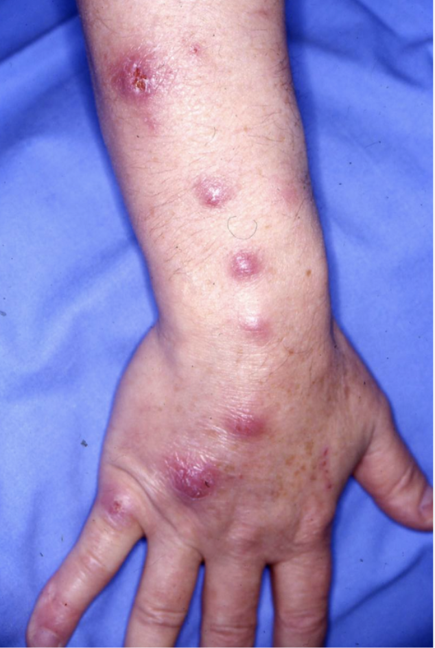 <p>Linked to fish tanks, aquariums, and swimming pools that presents as chronic skin nodule or ulcer after trauma/exposure</p>