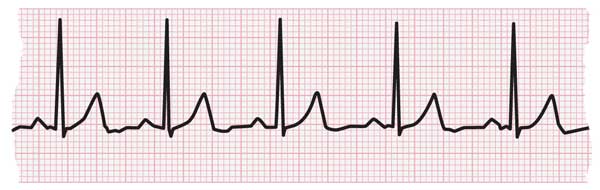 <p>What is the reading of this ECG?</p>