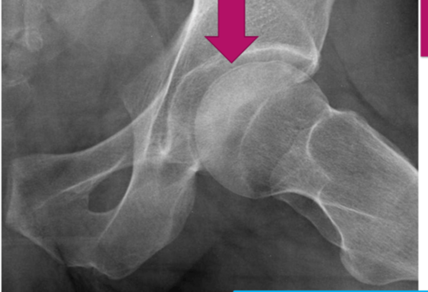 <p>AVN of femoral head- What is the name of this sign?</p>