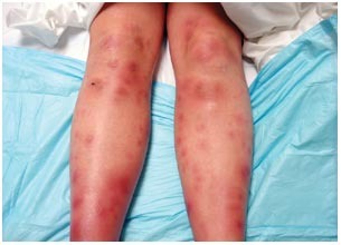 <p>- tender red nodules that are usually found on the shins</p><p>- associated with sarcoidosis</p>