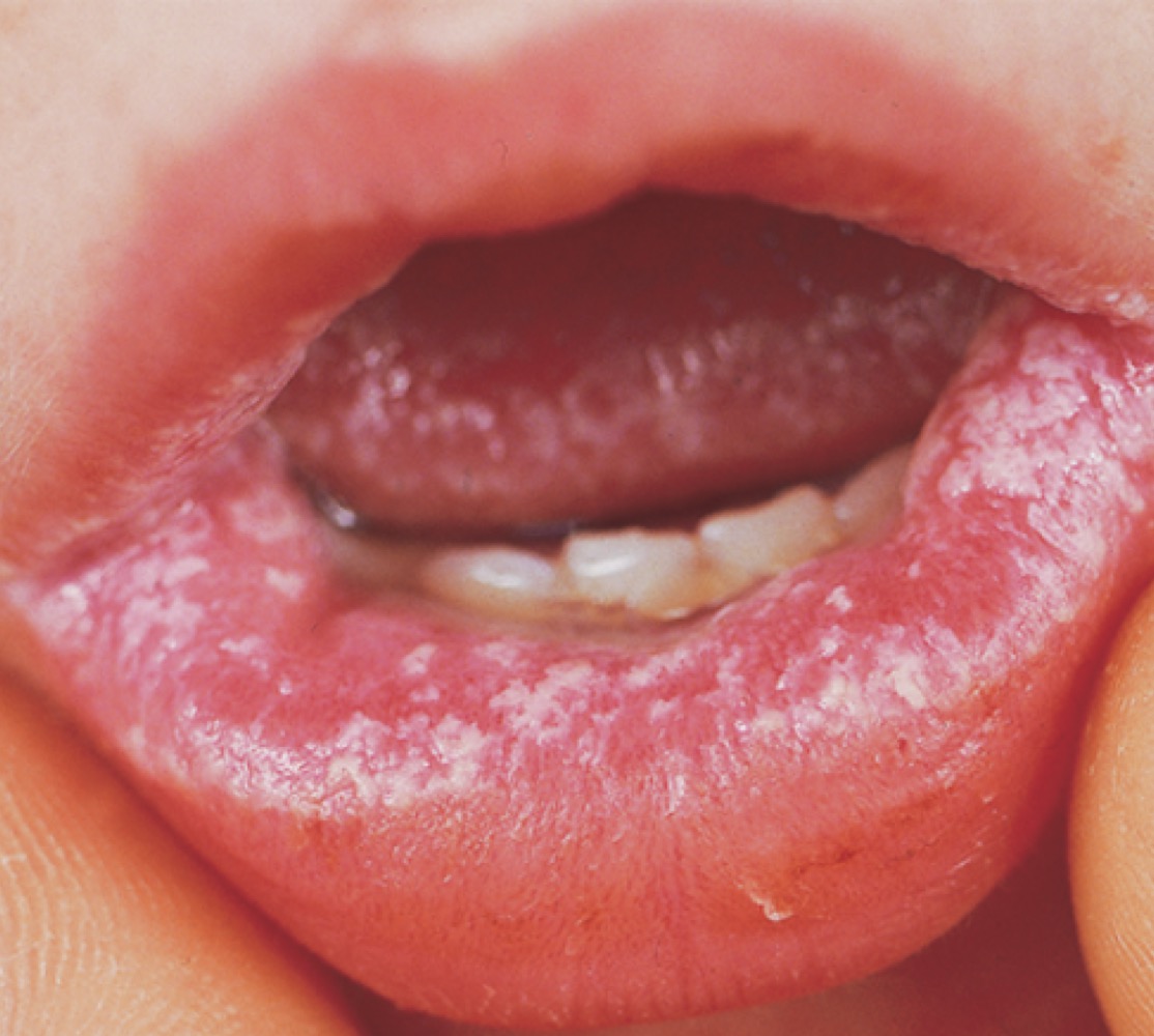 What is this?

A. Shingles

B. Small pox

C. Herpes

D. Candida