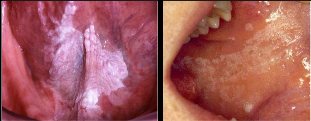 <p>which is leukoplakia, which is chewing trauma </p>