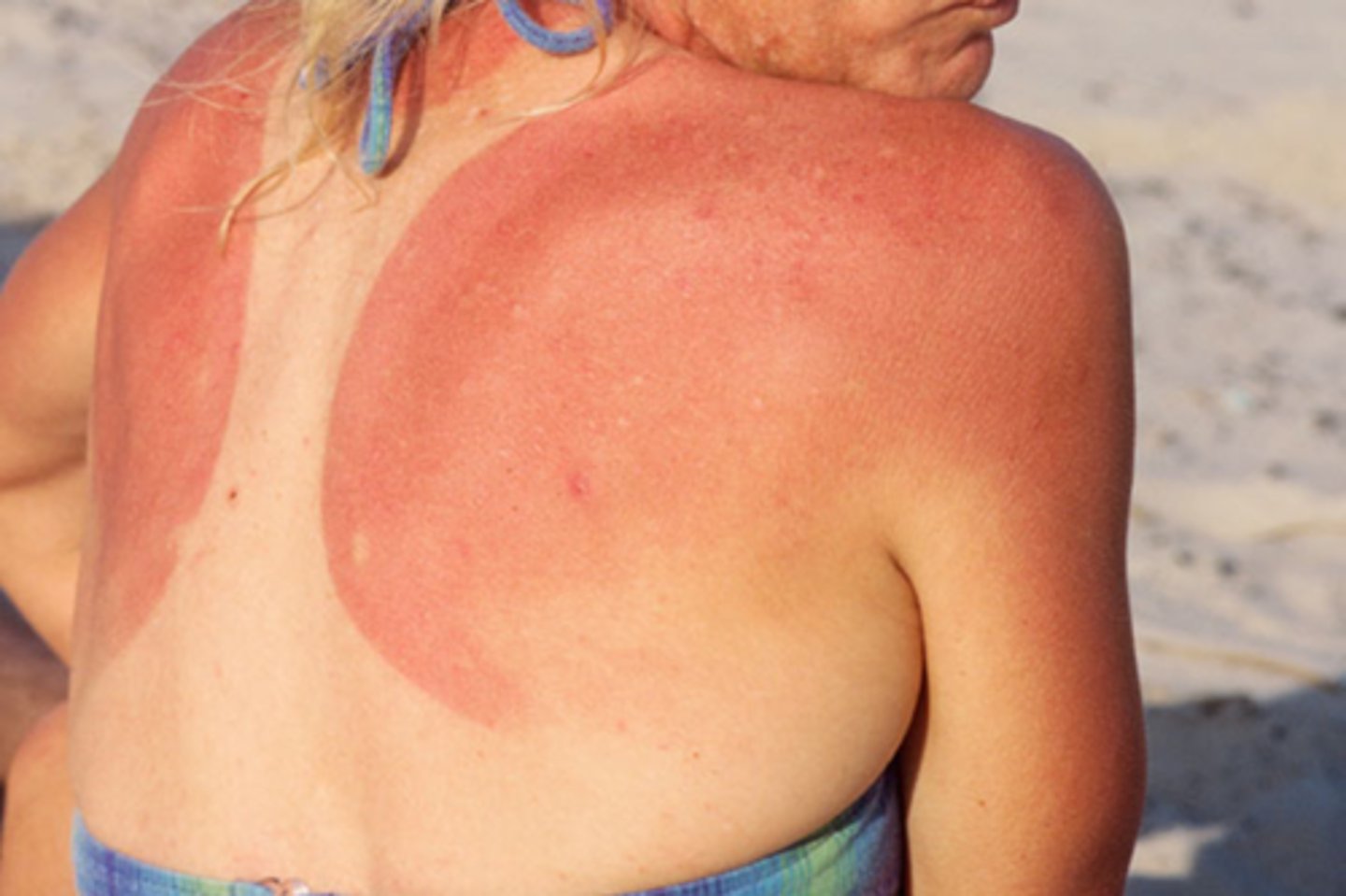 <p>sun burn - light pink skin</p>
