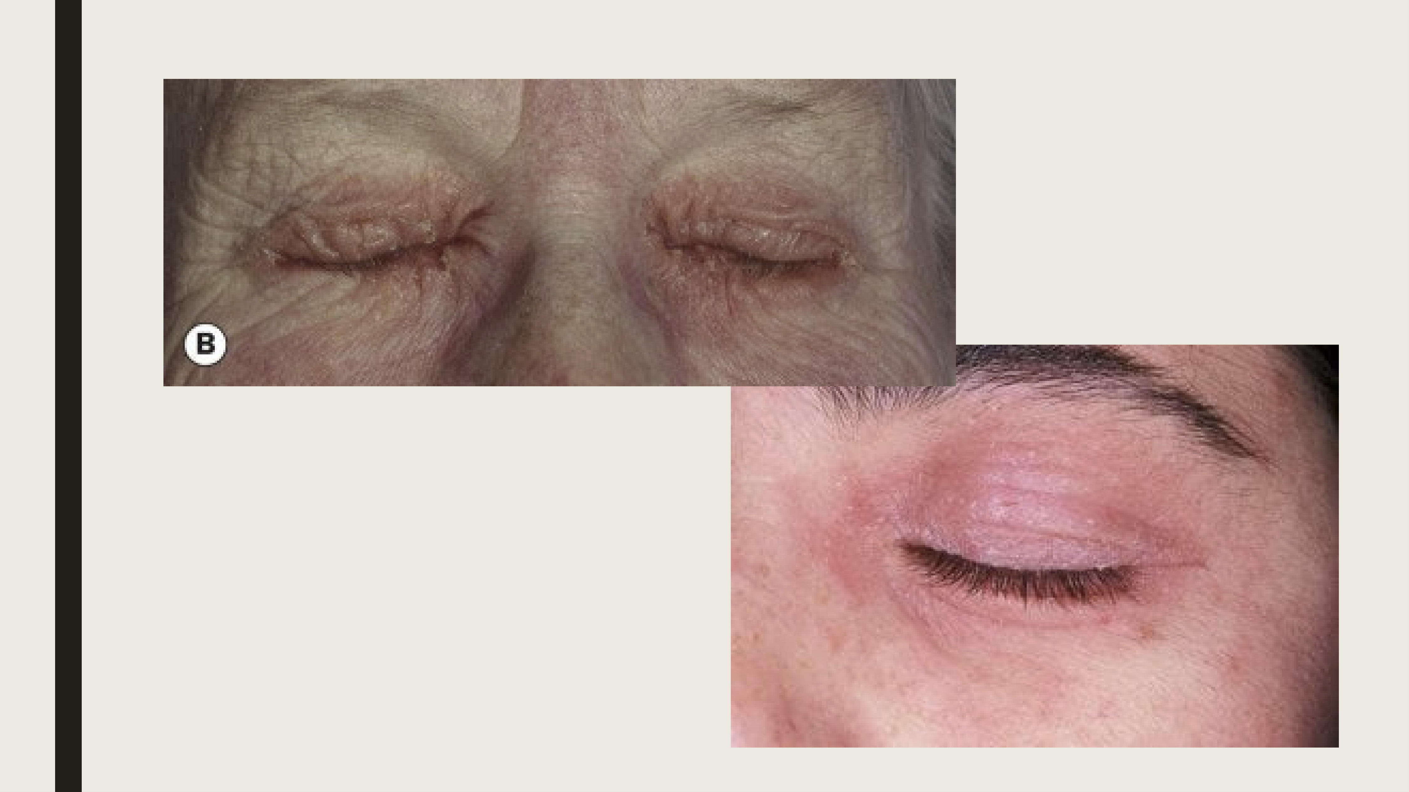 <ul><li><p>Eyelid itching with hyperemia </p></li><li><p>Lid edema and scaling of the eyelide</p></li><li><p>Conjunctival chemosis, hyperemia, and papillary reaction</p></li><li><p>PEE (Punctate corneal epithelial erosions)</p></li></ul><p></p>
