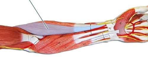 Proximal lateral supracondylar ridge of the humerus; lateral intermuscular septum