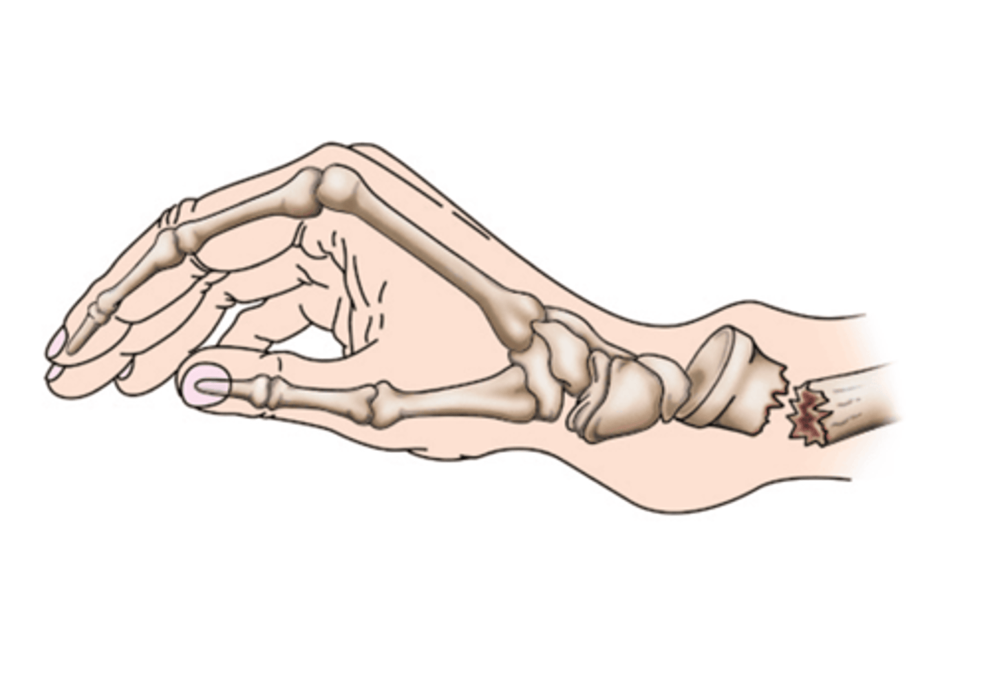 <p>distal portion of the distal bone pointing towards the dorsum (back) of the hand</p>