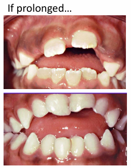 <p>-pacifier or fingers</p><p>-ideally stop by 3 years</p>