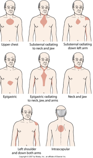 <p>Angina is the clinical manifestation of reversible cardiac ischemia</p><p>Characteristics</p><ul><li><p>Chest pain that occurs intermittently over long period of time</p></li><li><p>Same pattern of onset, duration and intensity</p></li><li><p>Pain at rest is unusual</p></li></ul><p></p>