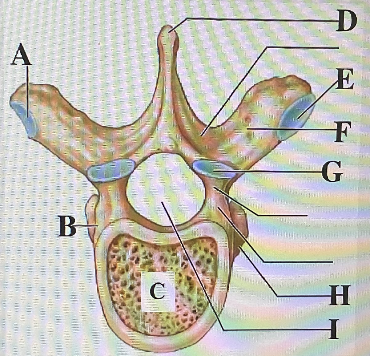 <p>in the figure above letter ___ is the transverse process and letter ____ is the vertebral body </p>