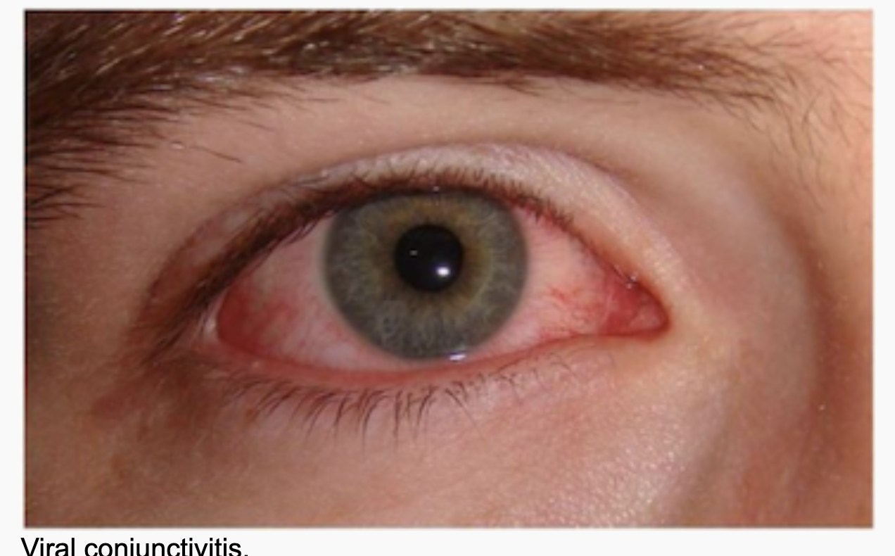 <p>Viral Conjuctivitis</p>