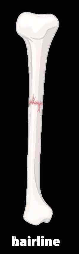 <p>No separation of bone “hairline fracture”</p>