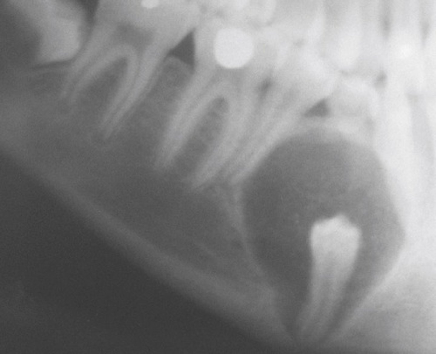 <p>encapsulated benign tumor; also called Odontogenic Adenomatoid Tumor (OAT)</p>