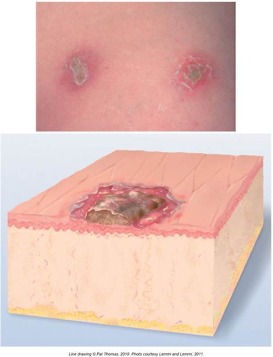 <p>thickened, dried exudate when a vesicle or pustule burst</p>