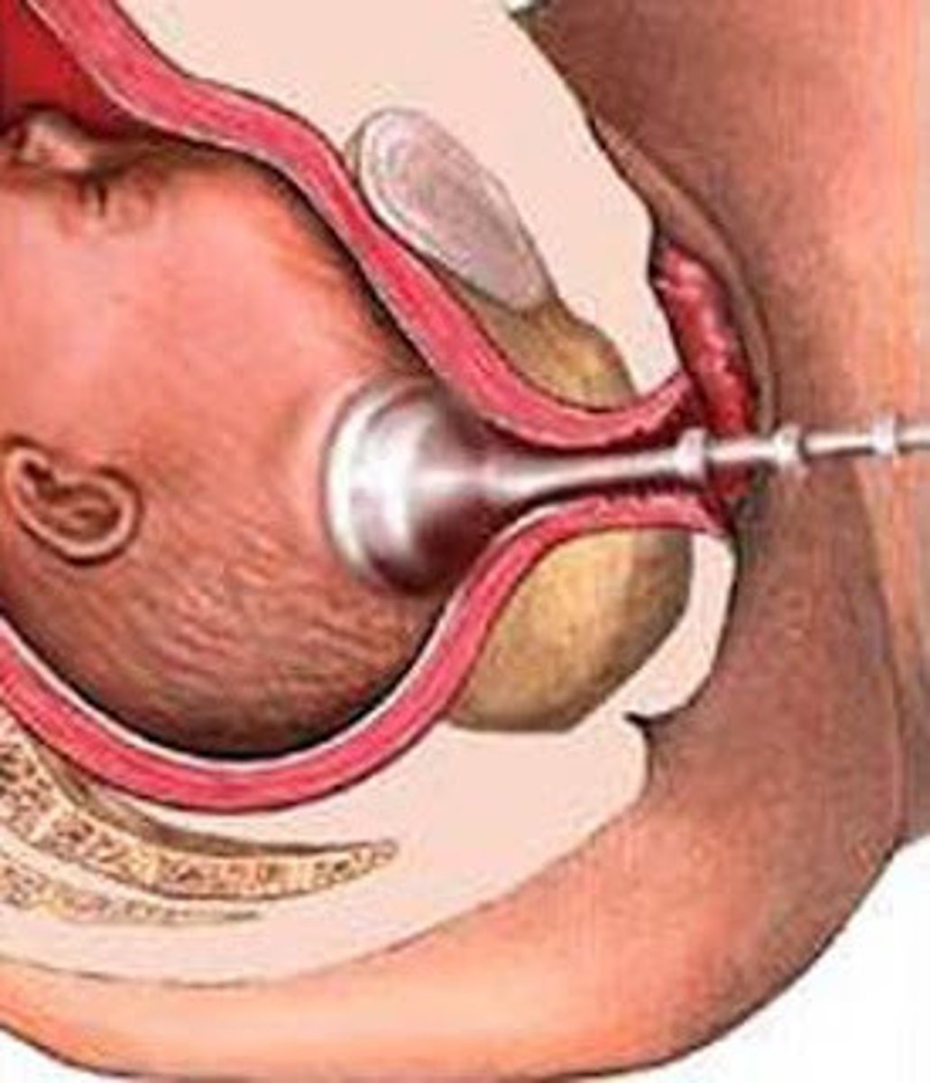 <p>is a device that applies suction to the fetal head to aid in extraction.</p><p>Cesarean deliveries are performed after three sets of pulls (traction) or a total application time of 15 to 30 minutes.</p>