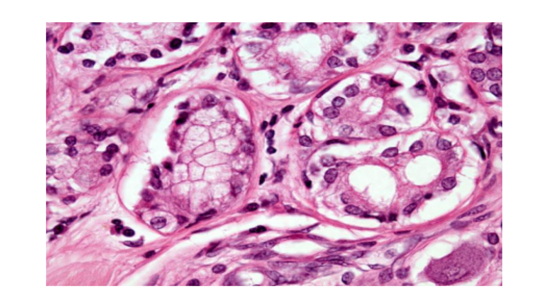 <p>Lung Adenocarcinoma</p>