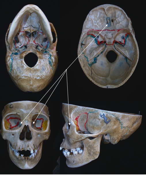 ethmoid bone 