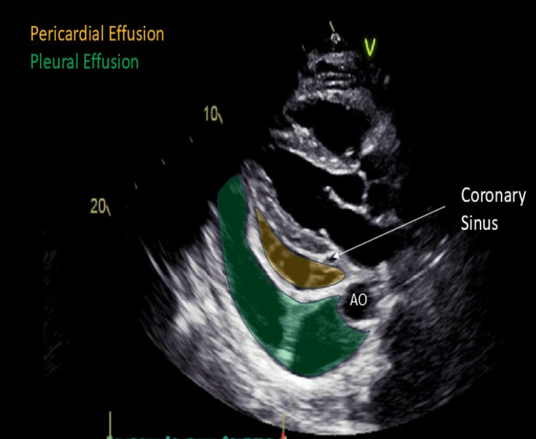 <p>Pericardial and pleural effusion </p>