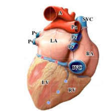 <p>-can see: inferior vena cava, right ventricle, left ventricle, interventricular sulcus (separating right and left ventricles)</p>