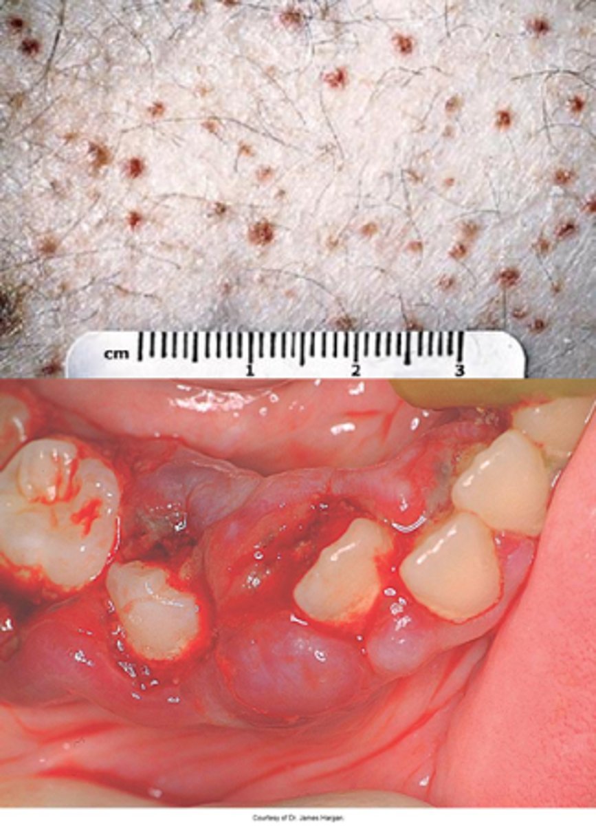 <p>The following are oral manifestations of a deficiency in what vitamin?</p><p>-Petechiae</p><p>•Generalized gingival swelling</p><p>•Hemorrhage (petechiae, ecchymosis)</p><p>•Tooth mobility</p><p>•Ulceration</p><p>•Increased periodontal infection</p><p>•Delayed wound healing</p>