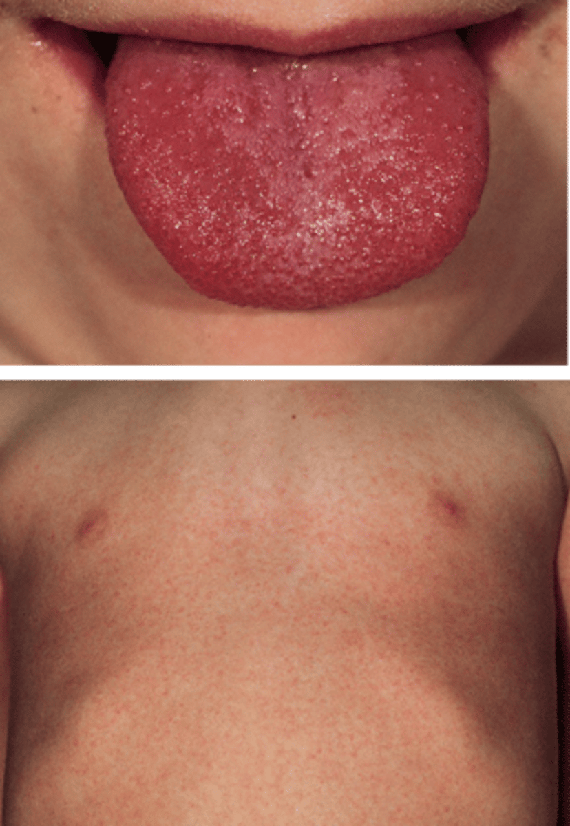 <p>erythrogenic toxin from bacteriophage, sandpaper-like rash, strawberry tongue</p>