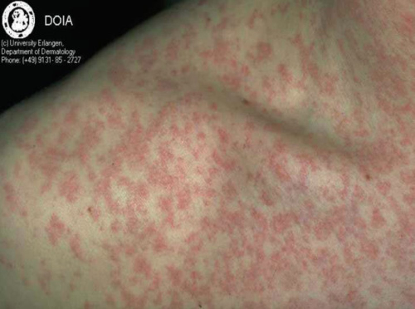 <p>an infectious viral disease <br>- causing <b>fever</b> and a <b>red rash on the skin</b><br>- cause <b>aches and pains</b><br>- spread by <b>inhalation of droplets</b><br>- typically occurring in <b>childhood</b><br>- should <b>avoid contact</b></p>