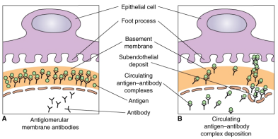 <ul><li><p><strong>Destruction of glomerular filtration membrane</strong> (due to inflammation) leads to <span style="color: red;"><strong>presence of red blood cells in urine</strong></span></p></li></ul><p></p>