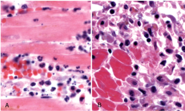 <p>What has happened to this myocardium</p>