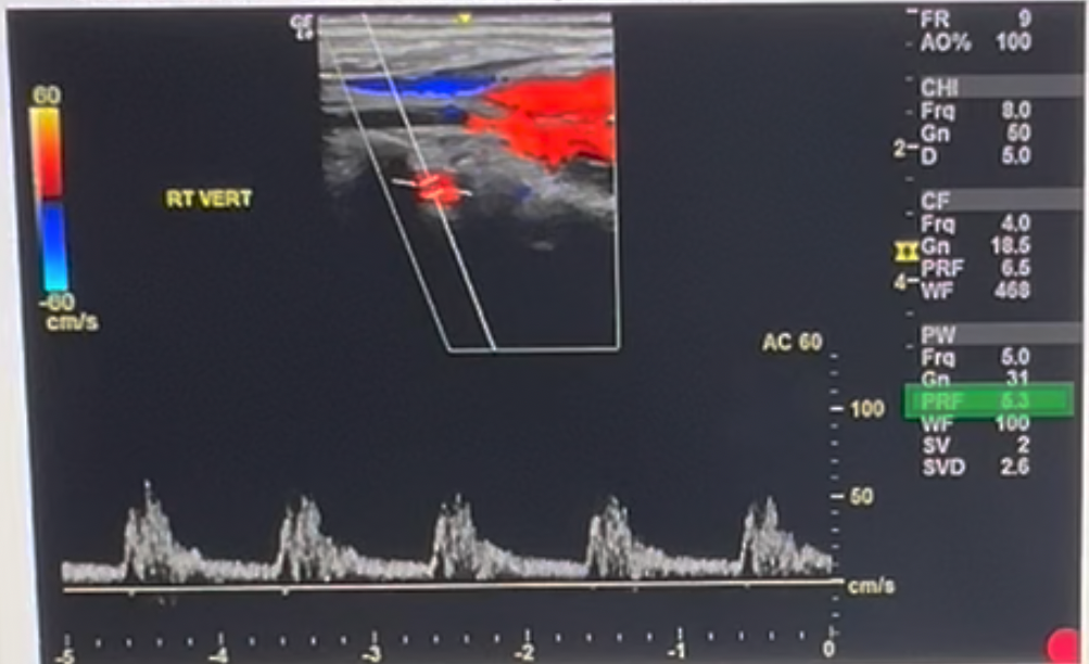 <p>Review the image and the system settings listed along the right side. Use your mouse to position your cursor over the setting that should be adjusted to improve the diagnostic quality of the Doppler tracing. Click to set the cursor and conform your answer.</p><p></p><p></p>