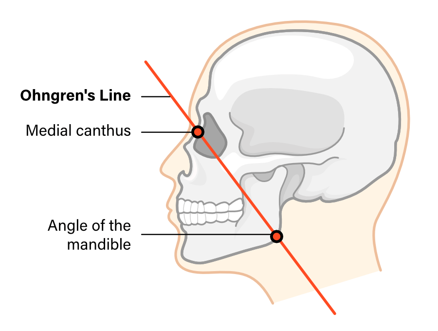 <ul><li><p>location (below Ohngren’s line is better, higher in skull is worse)</p></li><li><p>histology</p></li><li><p>locoregional extent</p></li><li><p>perineural</p></li></ul><p></p>