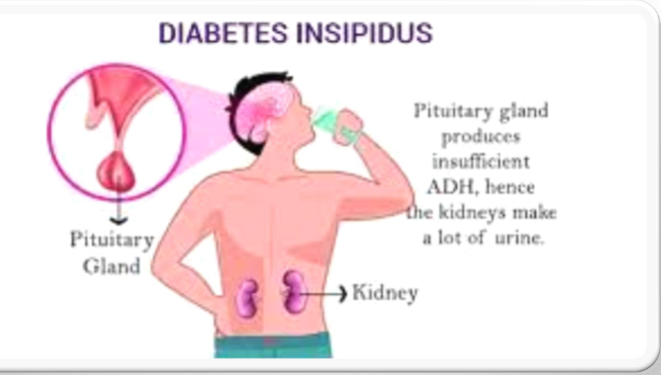 <p>peein a lot and very thirsy, argining vasopression insufficieny</p><p>no releiveing thirst and manage out put</p>