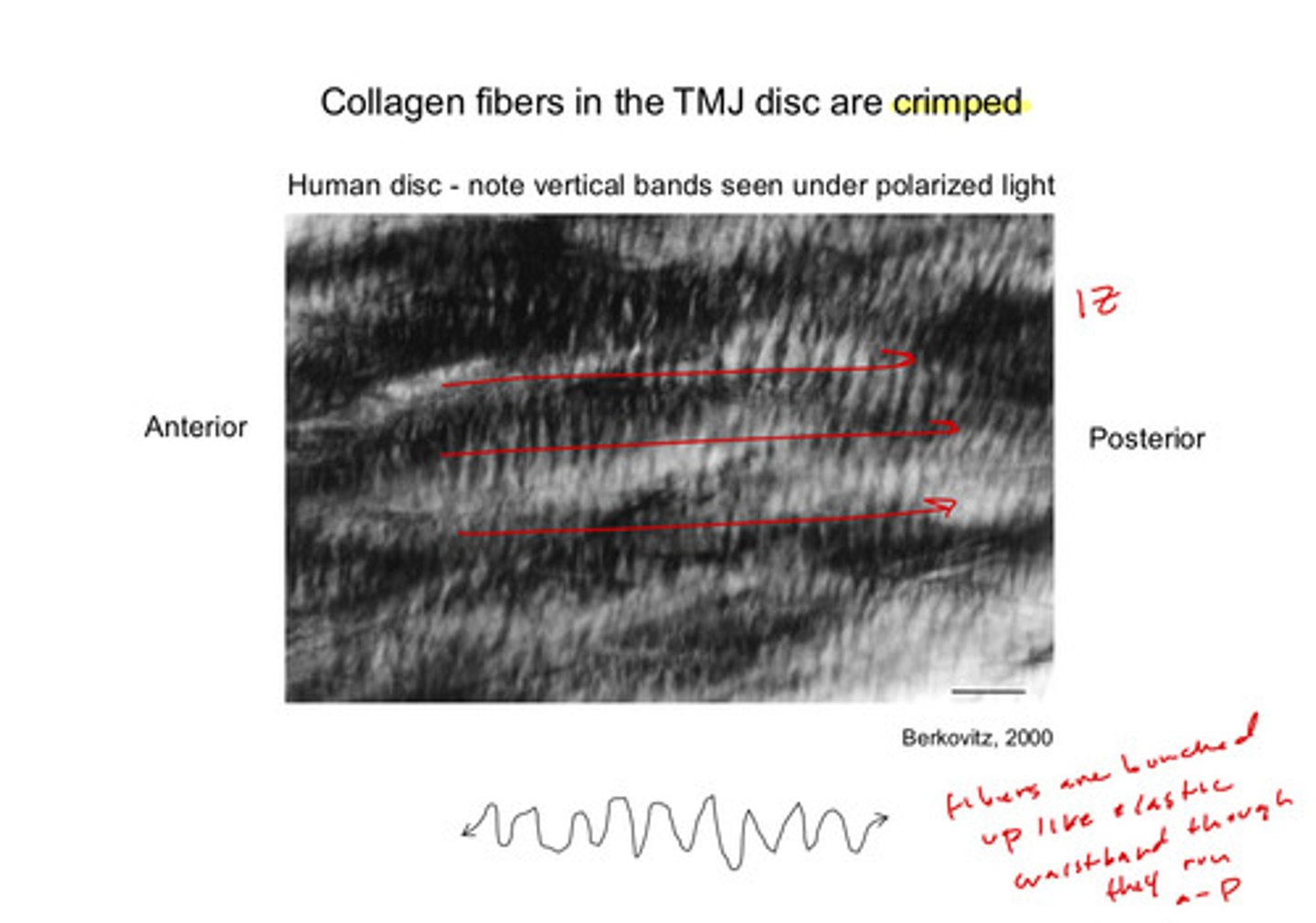<p>crimped! the fibers are bunched up like an elastic waistband, giving it a crimped look despite running mainly anterioposterior (in the central TMJ disc/intermediate zone)</p>