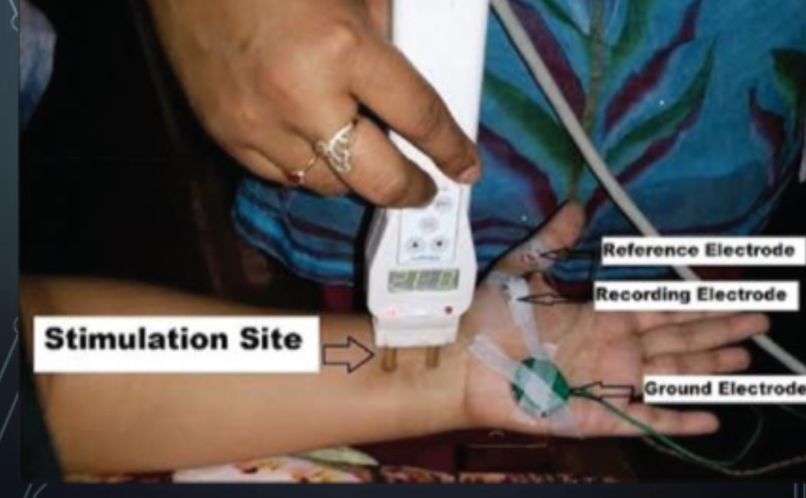<ul><li><p>Active/Recording: placed over the stimulated muscle/nerve</p></li><li><p>Reference: distally placed</p></li><li><p>Ground: placed on other areas usually on a<br>bony area</p></li></ul><p></p>