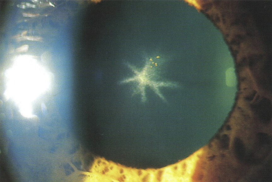 <ul><li><p>Anterior lenticular opacities in stellate appearance</p></li><li><p>Corneal endothelial deposits in interpalpebral fissure: rarely seen</p></li><li><p>Can give conj and sclera bluish hue </p></li><li><p>irreversible opacity, but little to no decrease in VA </p></li></ul><p></p>
