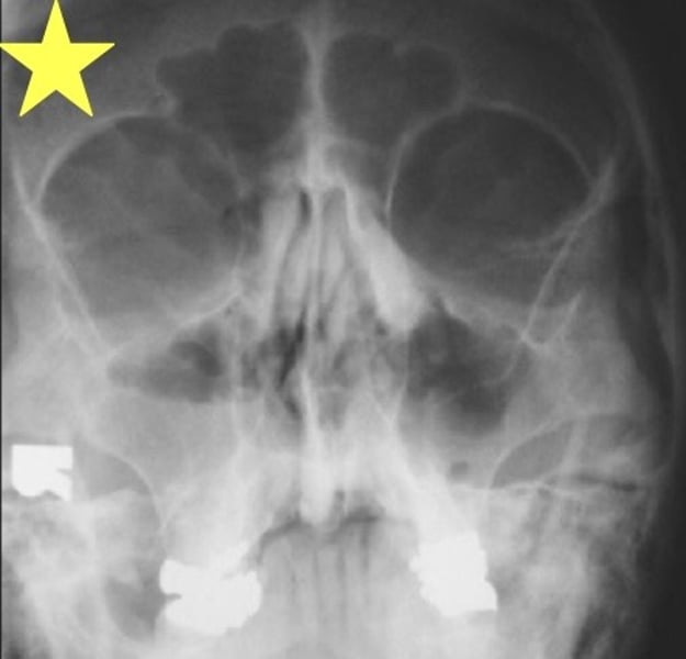 <p>Identify the radiographic abnormality. What view is this?</p>