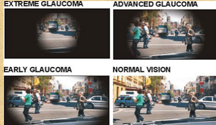 <p>Glaucoma </p>