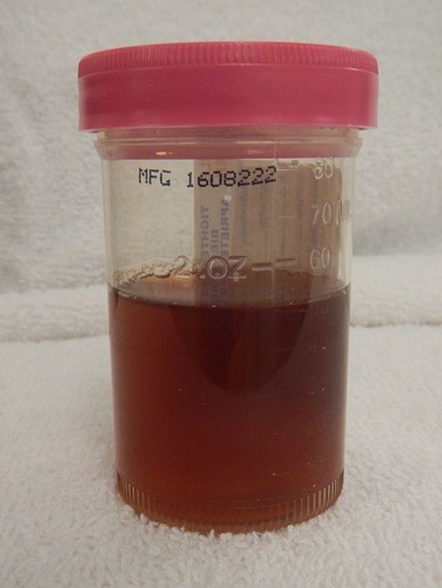 <p>when blood is in your urine </p>