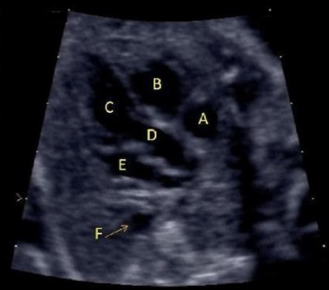 <p>what is letter B</p><p>a) LVOT</p><p>b) RVOT</p><p>c) left ventricle</p><p>d) right ventricle</p><p>e) right atrium</p>