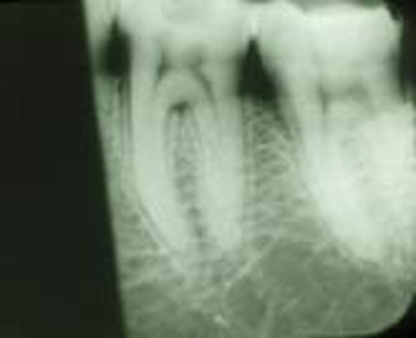 <p>A straght black border, film not completely immersed in fixer.</p>