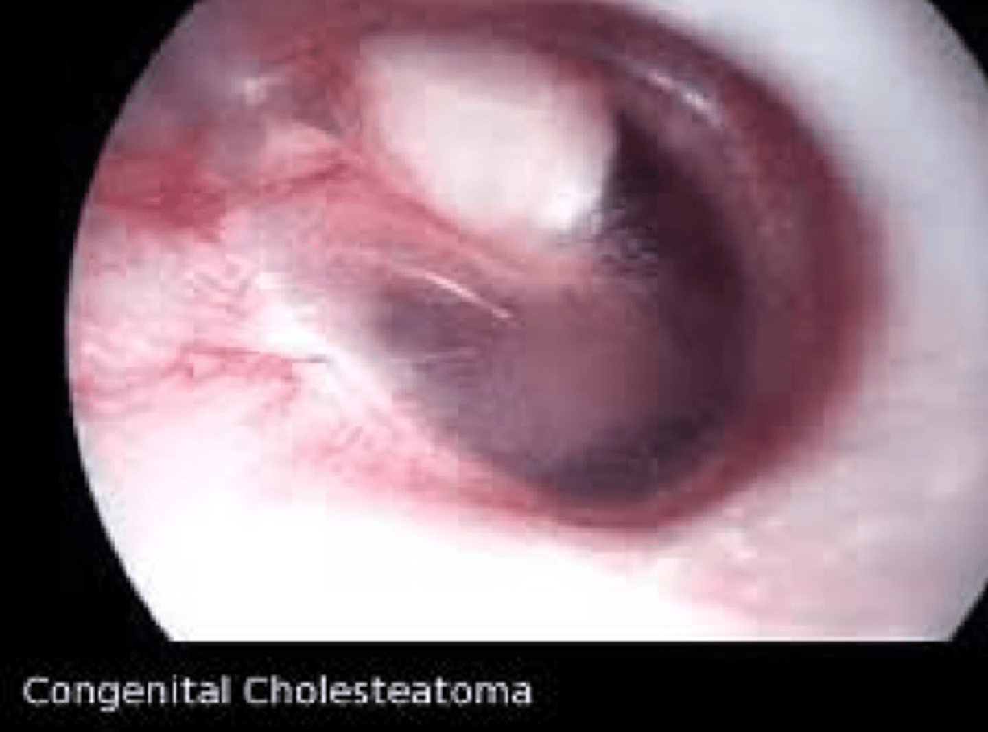 <p>Cholesteatoma</p>