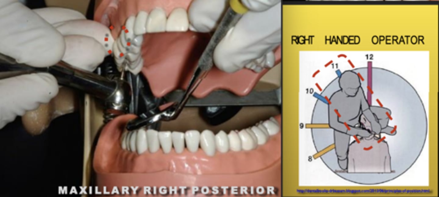 <p>Zone: 11</p><p>Vision: Indirect</p><p>Patient's Head: Center</p><p>Fulcrum: Max Right Posterior (B)</p>